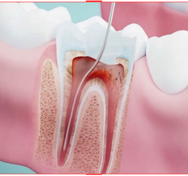 https://sakaryacarkdispoliklinigi.com/wp-content/uploads/2023/10/ENDODONTI-640x600.png